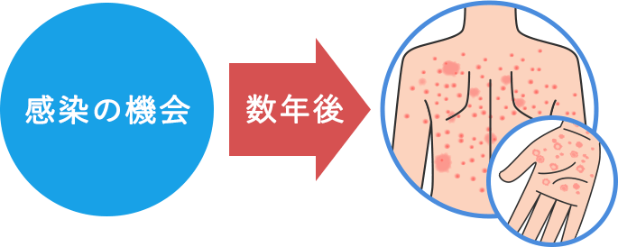 感染の機会から数年後
